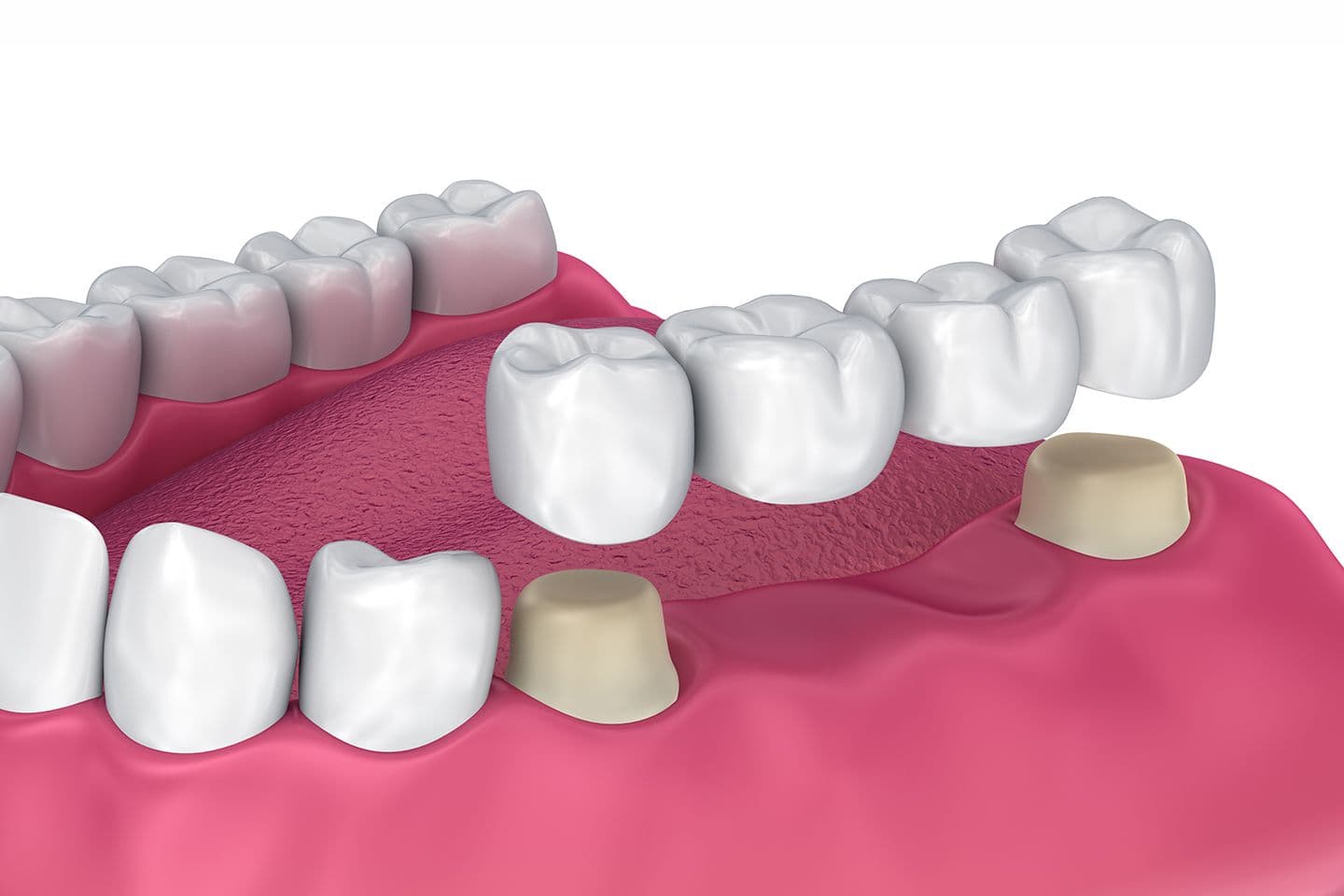 Bridges and Partial Dentures
