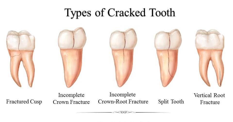 Cracked Teeth Repair