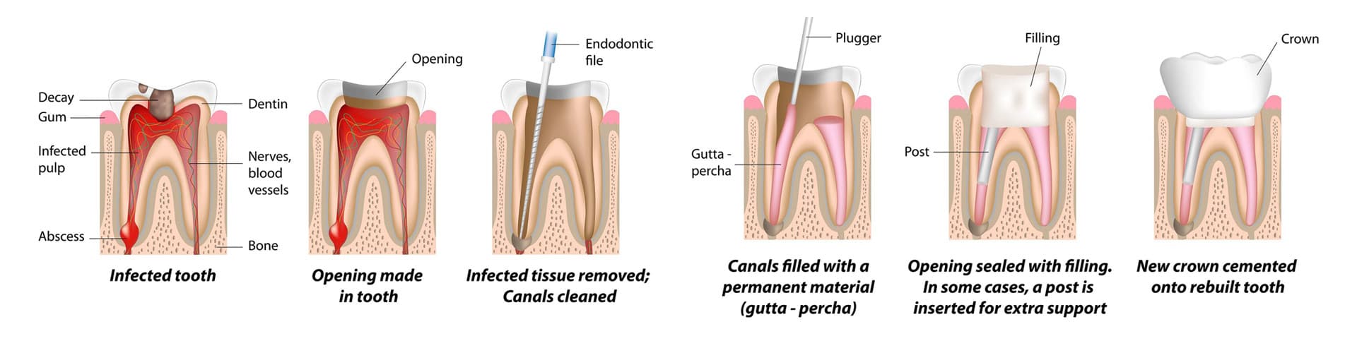 Root Canal Therapy
